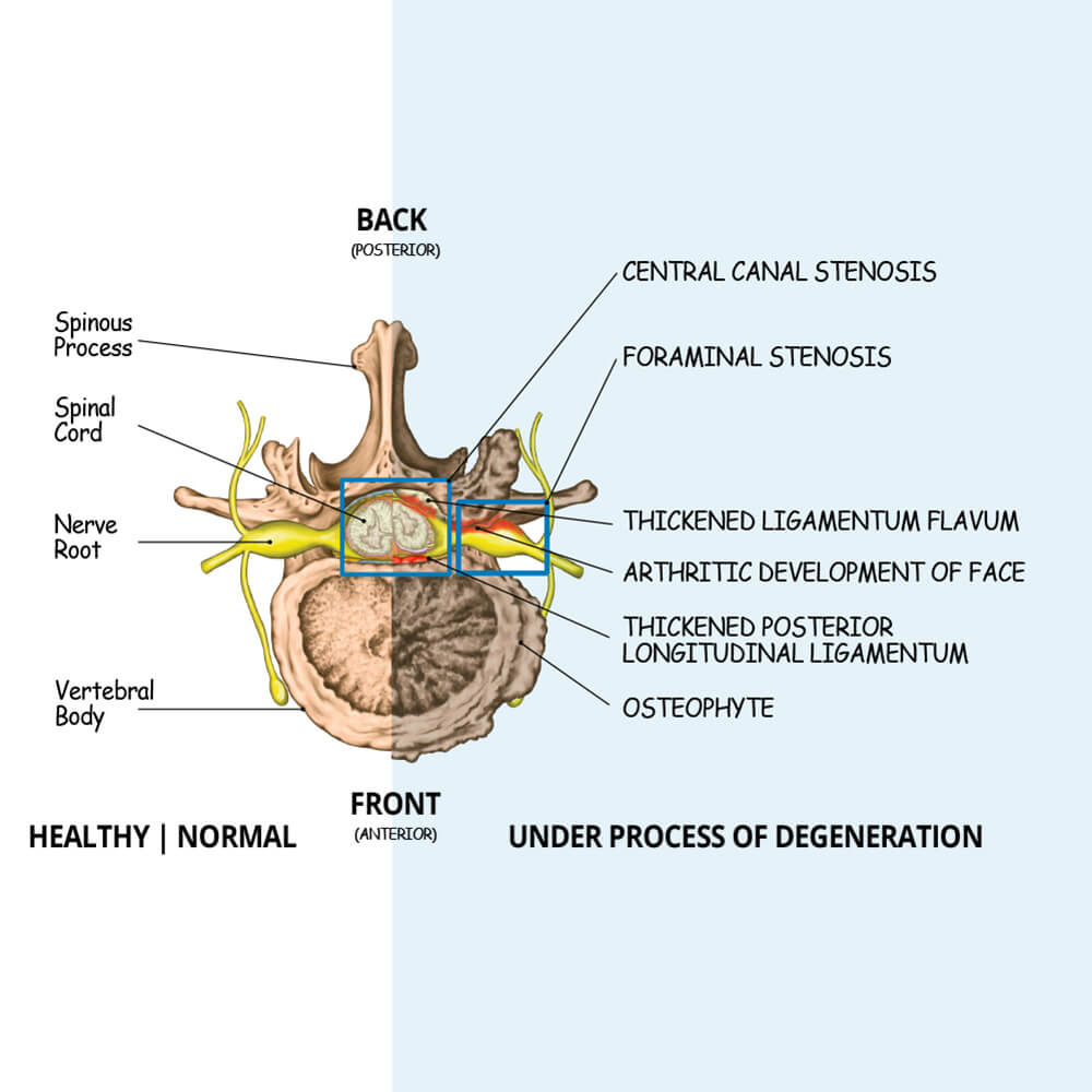 Spinal Stenosis Illustration showing how Central Stenosis and Foramnial Stenosis occur
