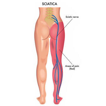 Image showing Sciatic Nerve and Sciatic Pain Pattern down right leg