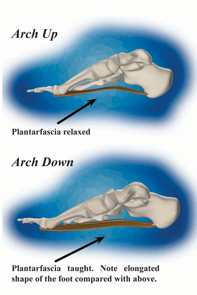 Plantar Fasciitis Foot Diagram - Plantar Fasciitis Arch Up and Arch Down