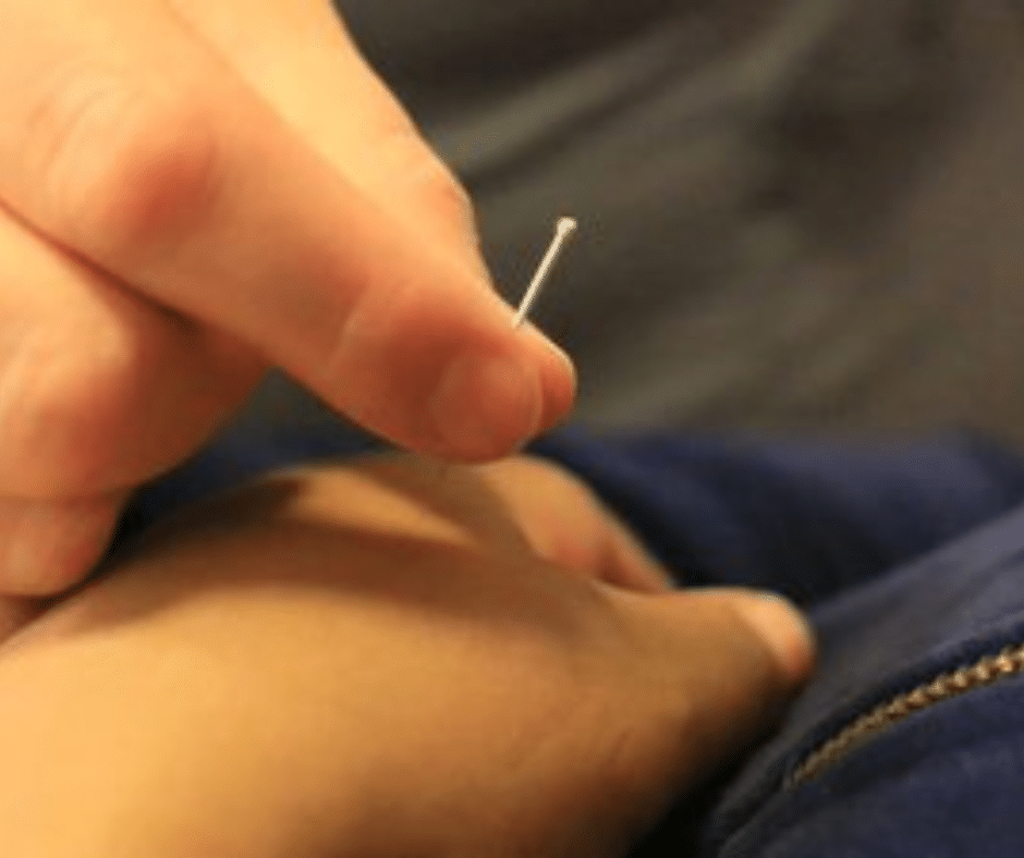 Chicago Acupuncturist Dr. Marlena uses hand acupuncture at Ravenswood Chiropractic in Chicago