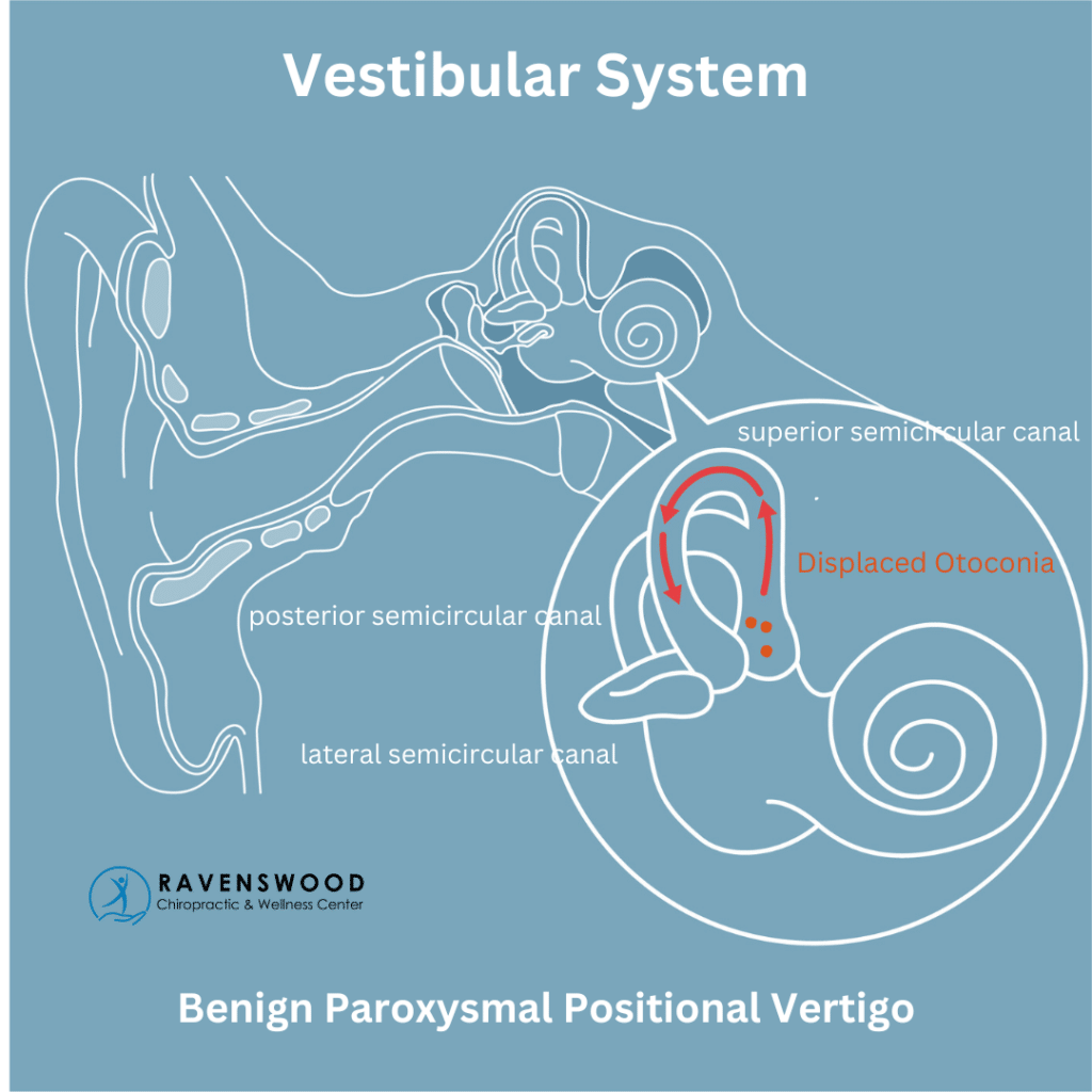Illustration of Vestibular System showing how Calcium deposits in the semicircular canals can become dislodged and cause dizziness and balance symptoms
